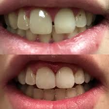 لمینت دندان خرگوشی