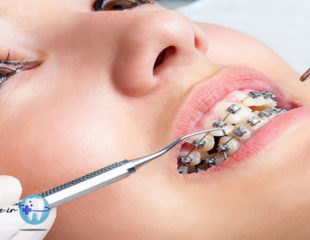 ارتودنسی دندان