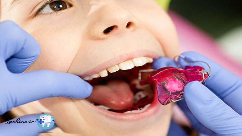 هزینه ارتودنسی دندان کودکان
