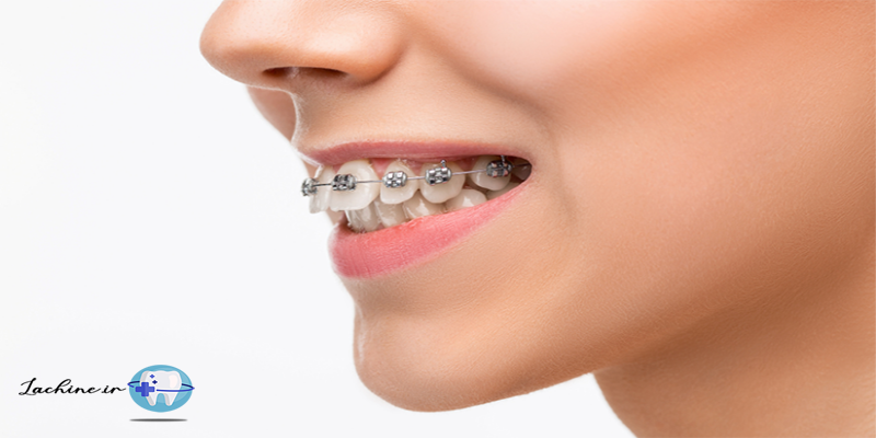 فواید ارتودنسی دندان