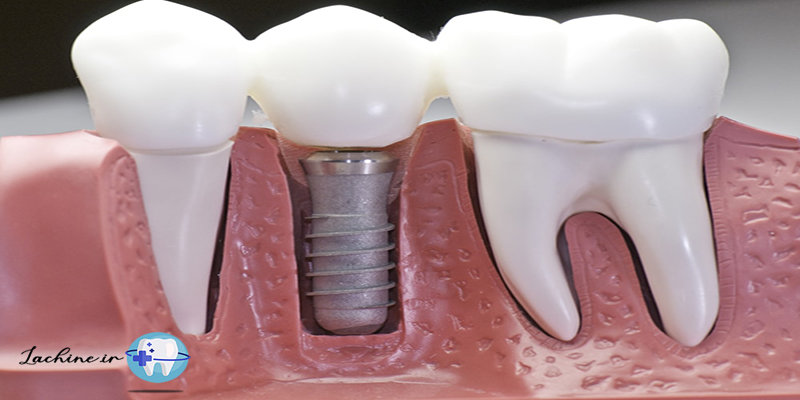 ارتودنسی بهتر است یا ایمپلنت