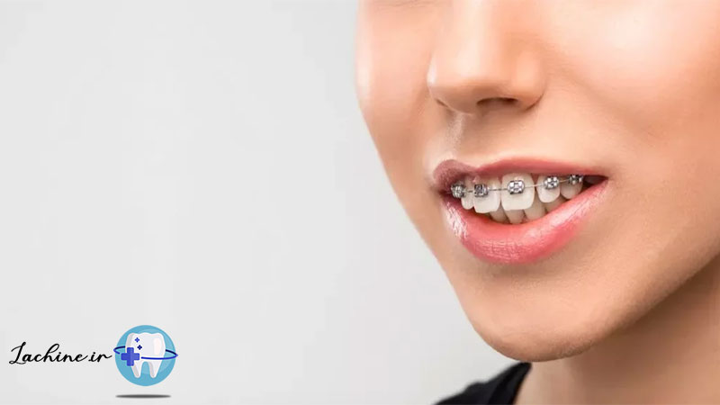 اوربایت دندان چیست