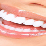 ونیر دندان چیست