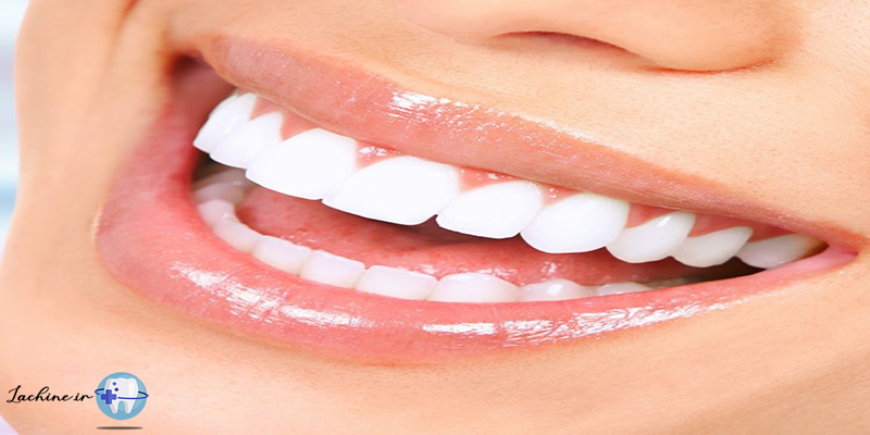 ونیر دندان چیست