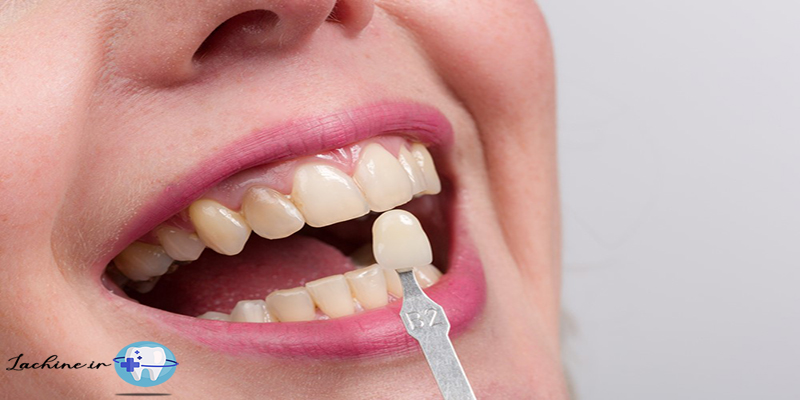 بلیچینگ دندان بهتر است یا کامپوزیت
