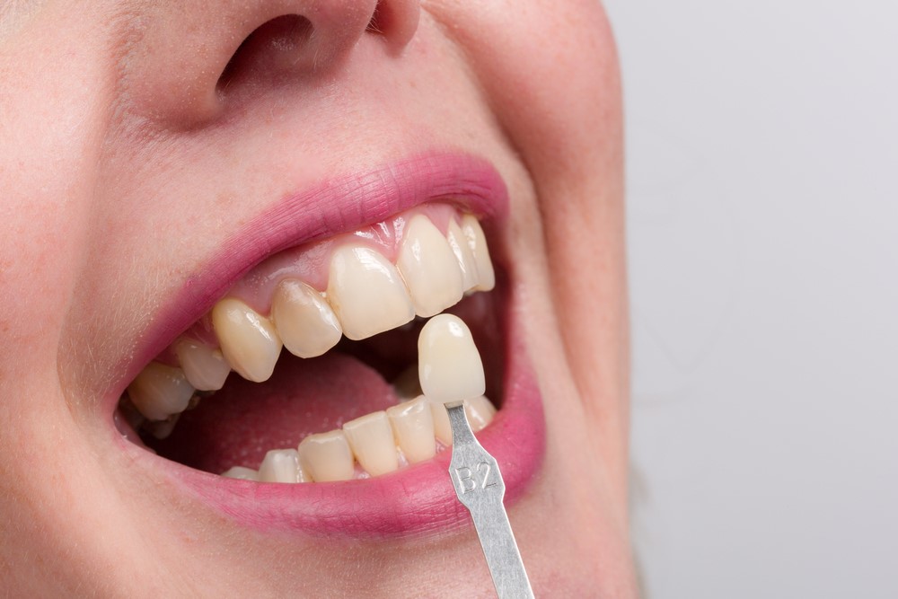 بلیچینگ دندان بهتر است یا کامپوزیت 