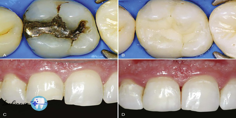 ترمیم دندان با کامپوزیت