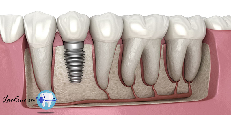 ایمپلنت دندان چیست