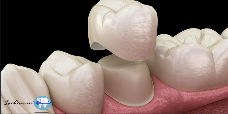 روشهای ترمیم و زیبایی دندان