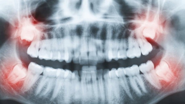 آیا اشعه ایکس دندان در هنگام بارداری مضر است