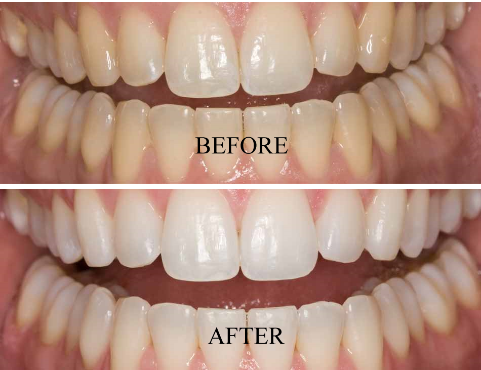 بلیچینگ دندان بعد از ارتودنسی