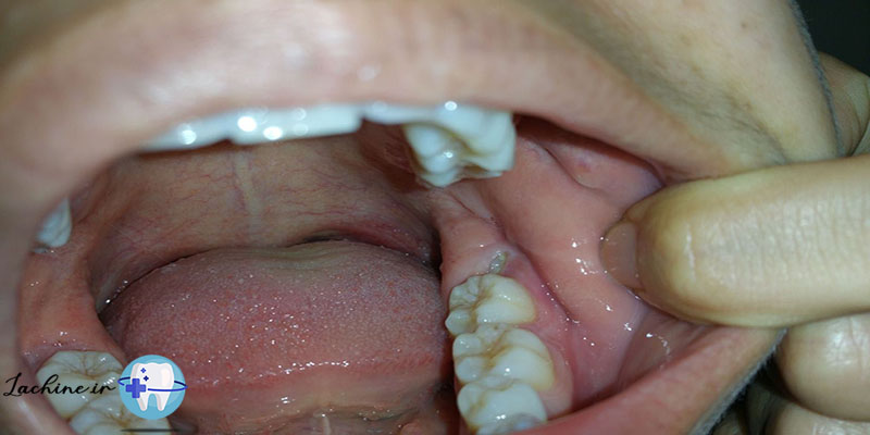 دندان عقل چندمین دندان است