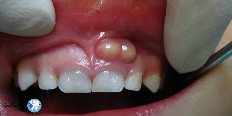 آبسه دندان درمان