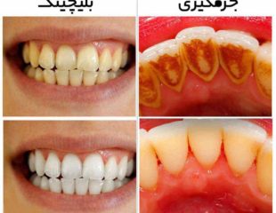 پک بلیچینگ دندان-1