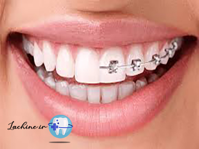 ارتودنسی رایگان دندان
