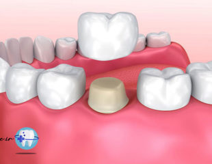 ترمیم دندان بدون تاج