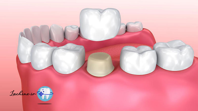 ترمیم دندان بدون تاج