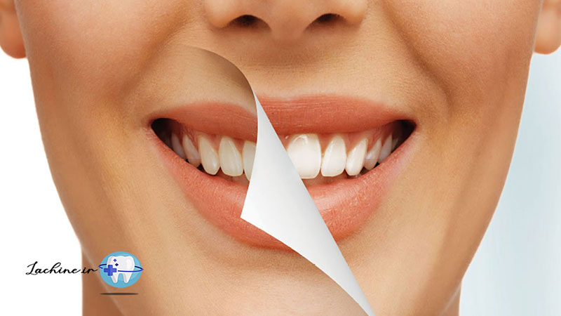 سفید کردن دندان‌