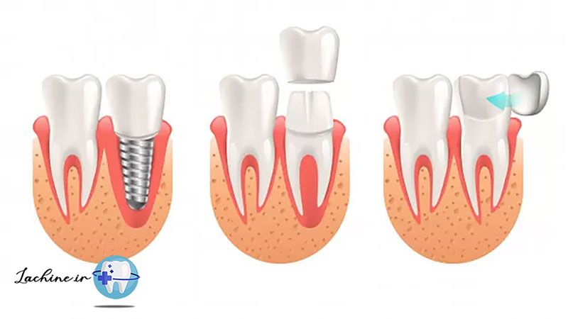 ترمیم با تاج دندان