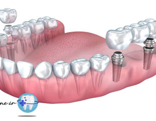 قیمت ایمپلنت دندان