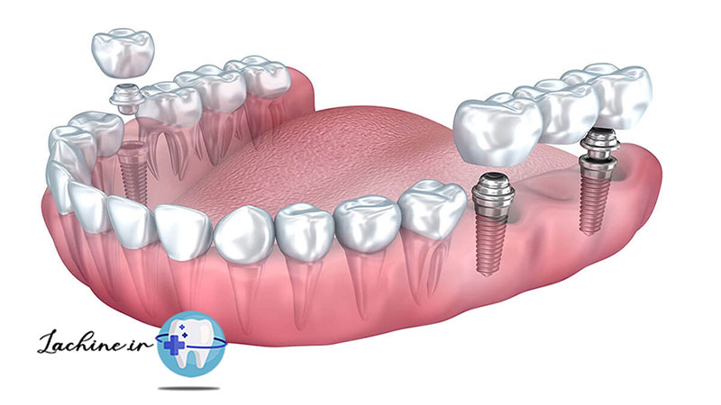 قیمت ایمپلنت دندان