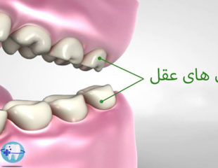 دندان عقل