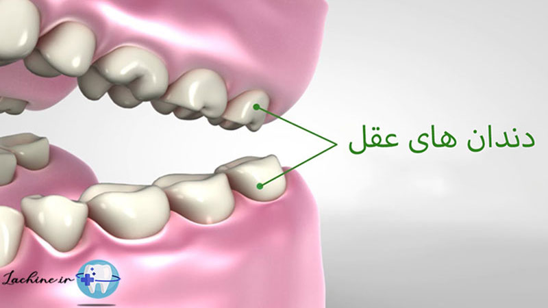 دندان عقل