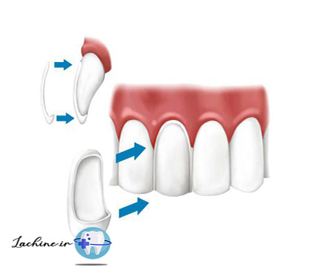 هزینه لمینت دندان در ایران