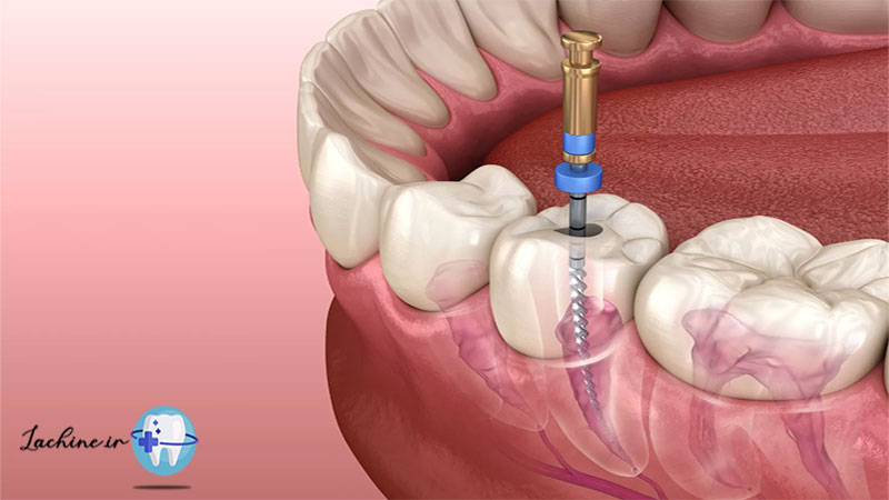 عصب کشی دندان برای درمان سه سوته دندان درد