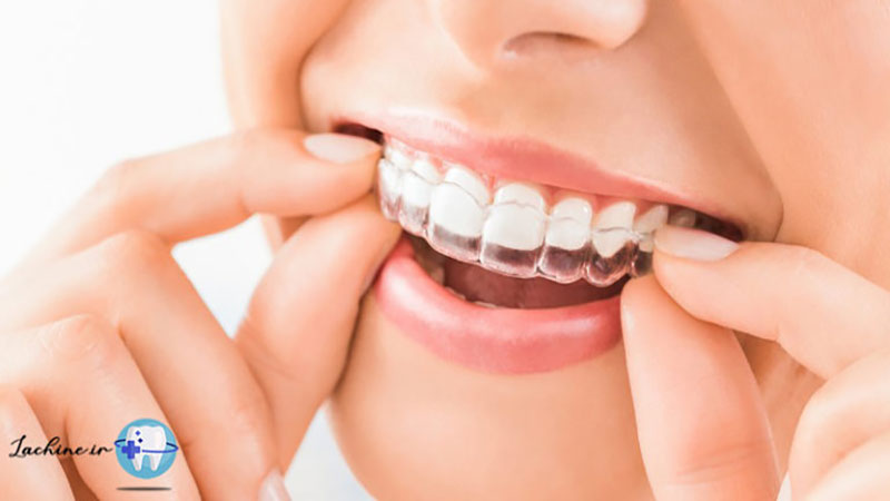 درمان برگشت دندان بعد از ارتودنسی
